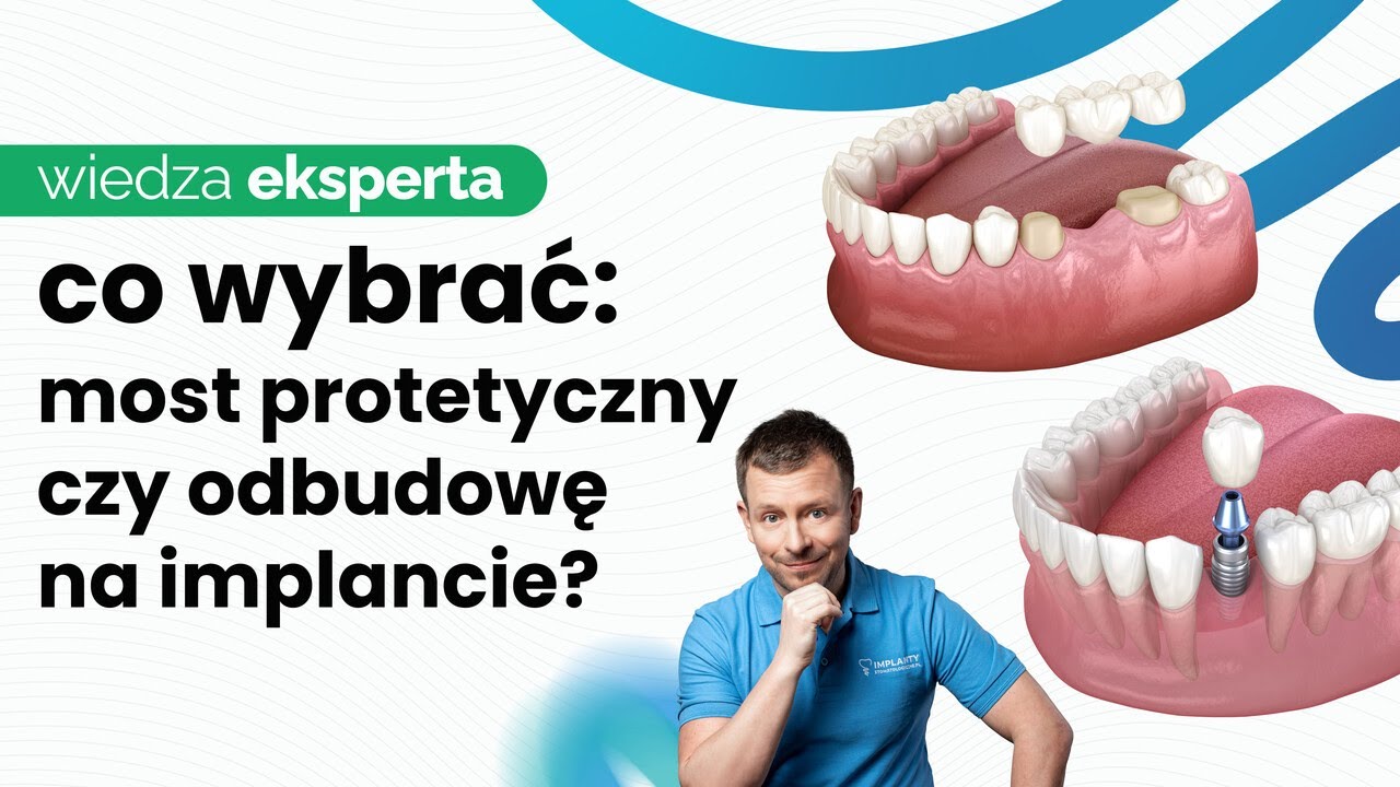 MOST NA IMPLANTACH A MOST NA ZĘBACH NATURALNYCH - KLUCZOWE RÓŻNICE