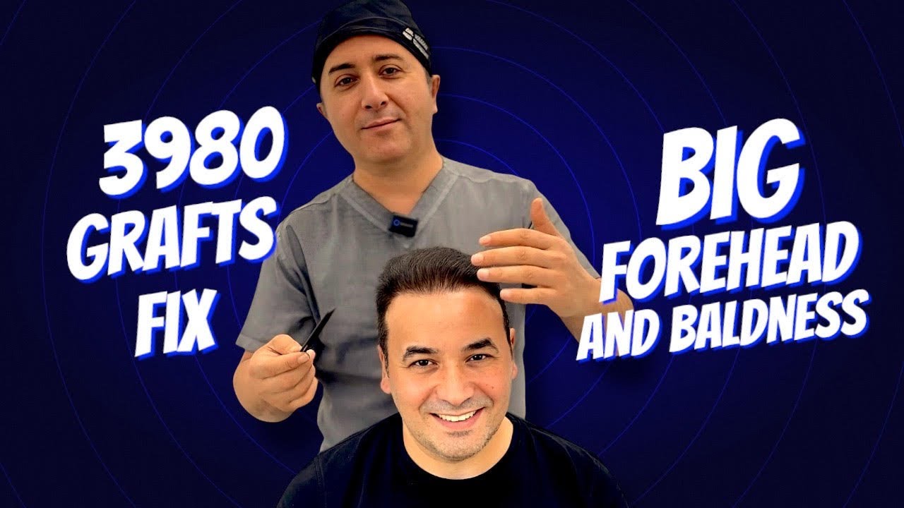 3980 Grafts Fix Big Forehead and Male Pattern Baldness - Dr. Resul YAMAN