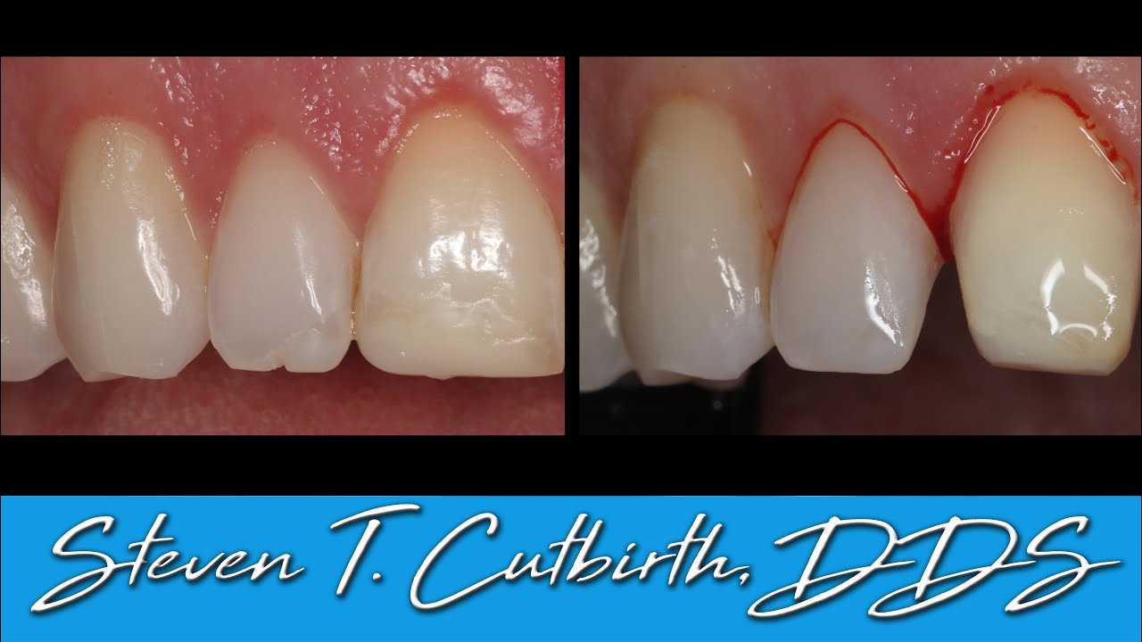 Composite Bonding of a Class 4 Fracture - Dental Minute with Steven T. Cutbirth, DDS