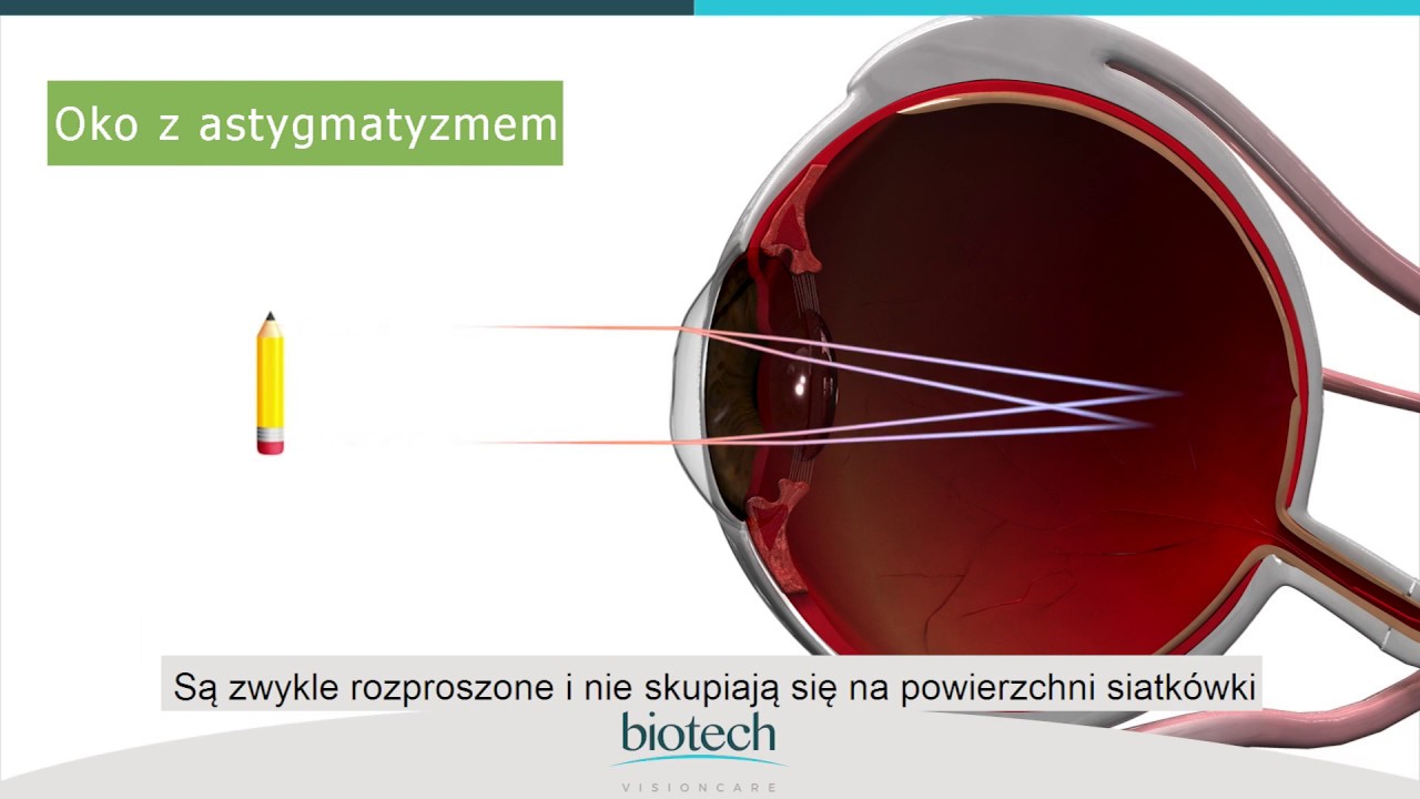 Astygmatyzm - na czym polega?