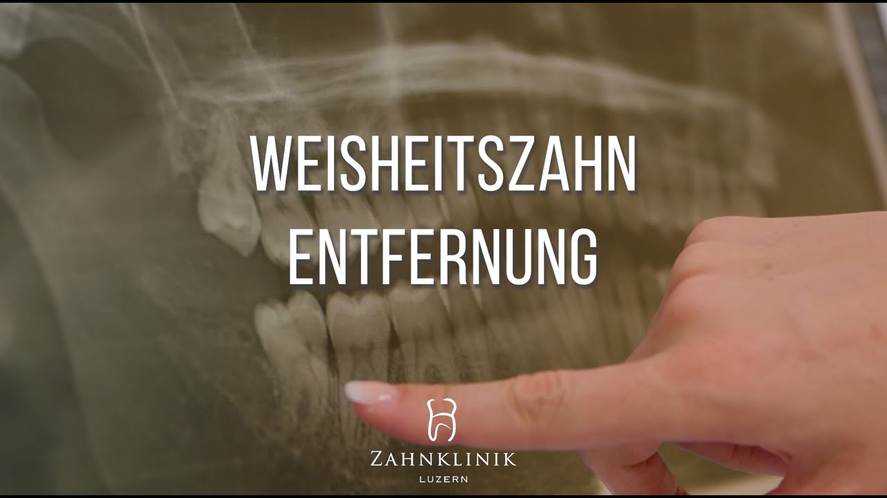 Weisheitszahn ziehen lassen - So läuft die Weisheitszahnentfernung ab!
