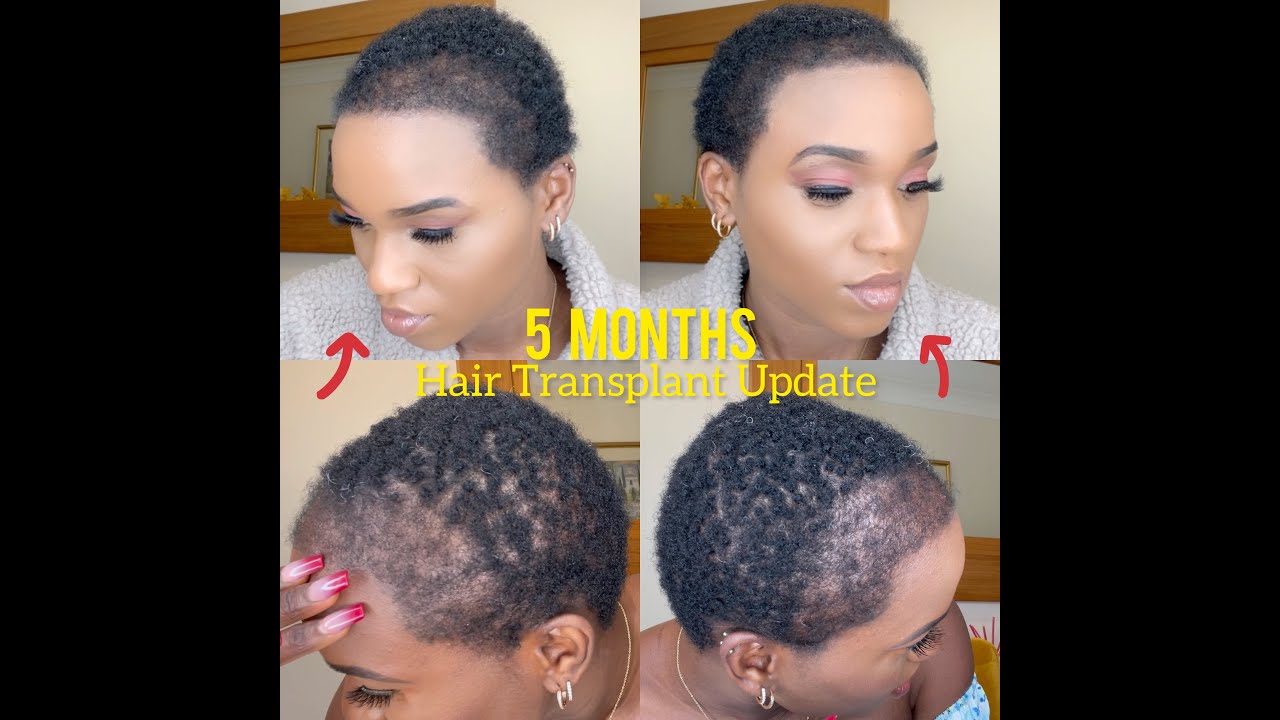 5 months Update | Afro Hair Transplant | Longevita | Turkey | BigForeHead