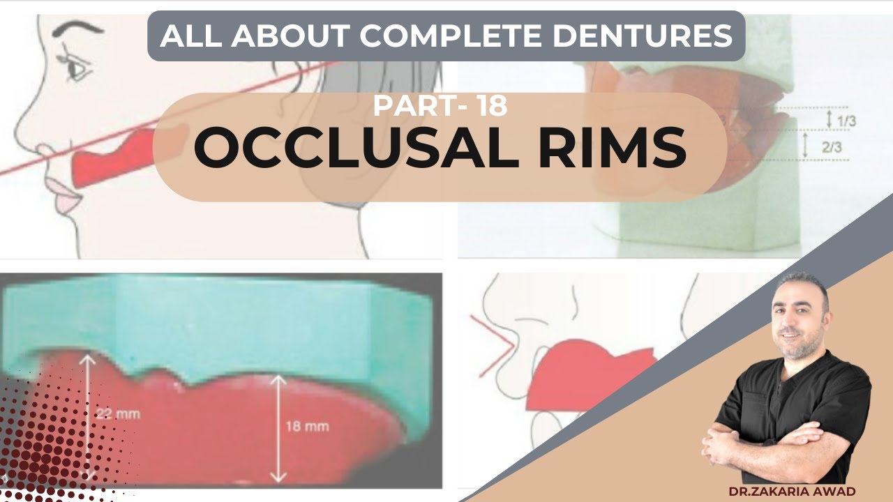18 - الارتفاعات الشمعية الاطباقية - OCCLUSAL RIMS - سلسلة التعويضات الكاملة المتحركة