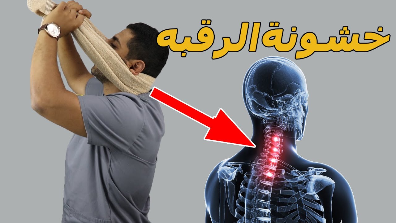خشونة الرقبة الاسباب والعلاج /وداعا الم  وخشونة الرقبة بدون جراحة وتحدي