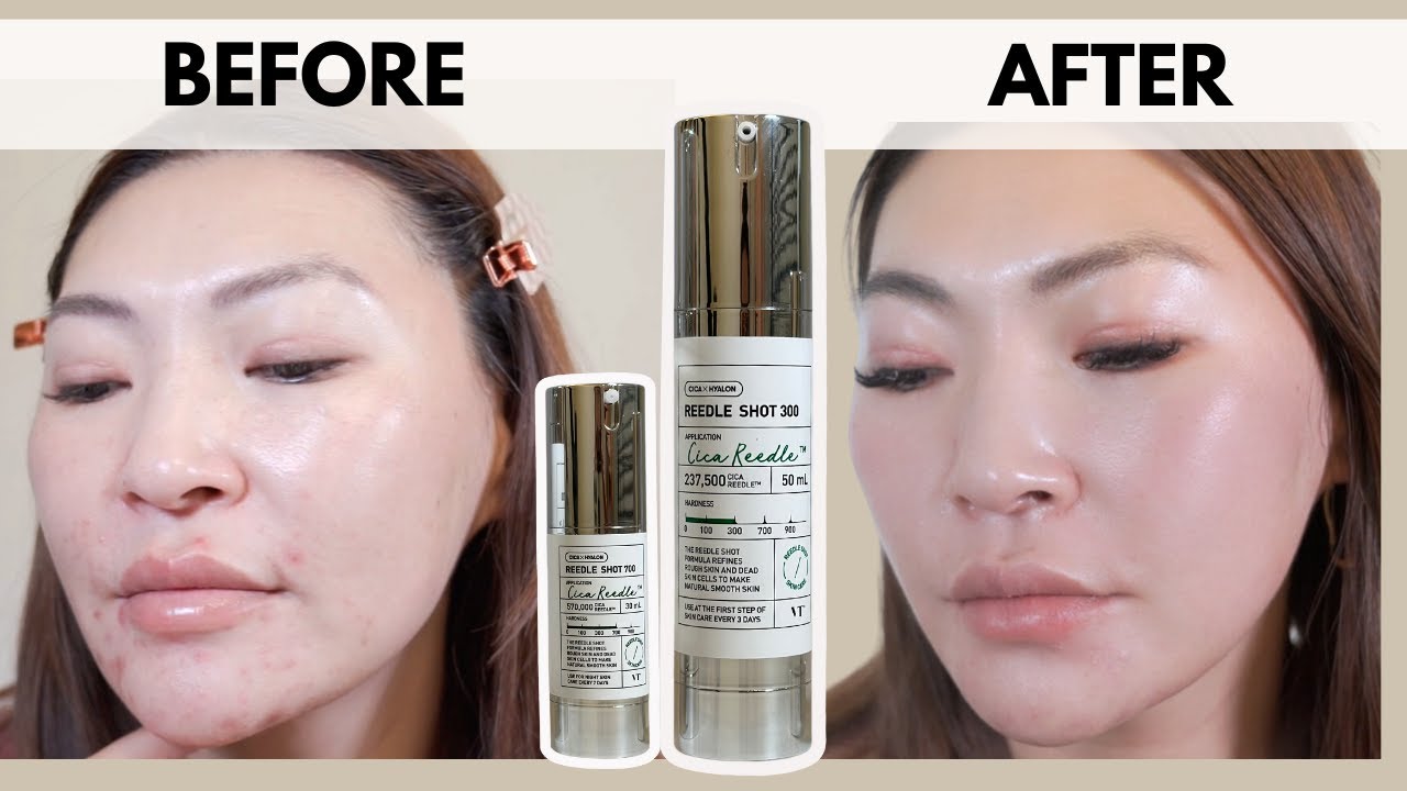 VT Reedle Shot Review! My Routine, Tips, Results & FAQ
