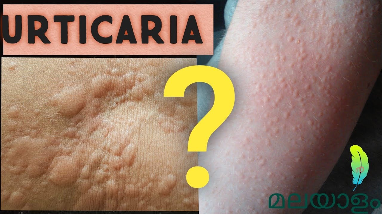 URTICARIA in Malayalam