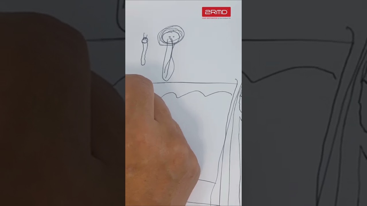 ¿Por qué se ven puntos blanco luego de la realización de un trasplante capilar?
