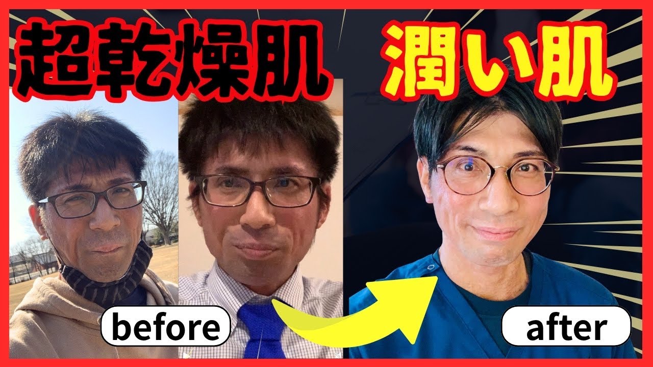 【ガチの超乾燥肌】40年間アトピーで、何をやっても潤わないガサガサ乾燥肌が、なんと‼？潤ってきた！！