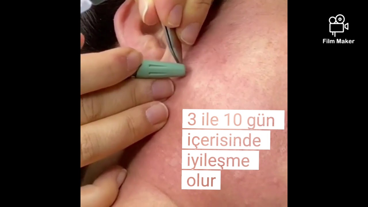 İğneli epilasyon Beylikdüzü