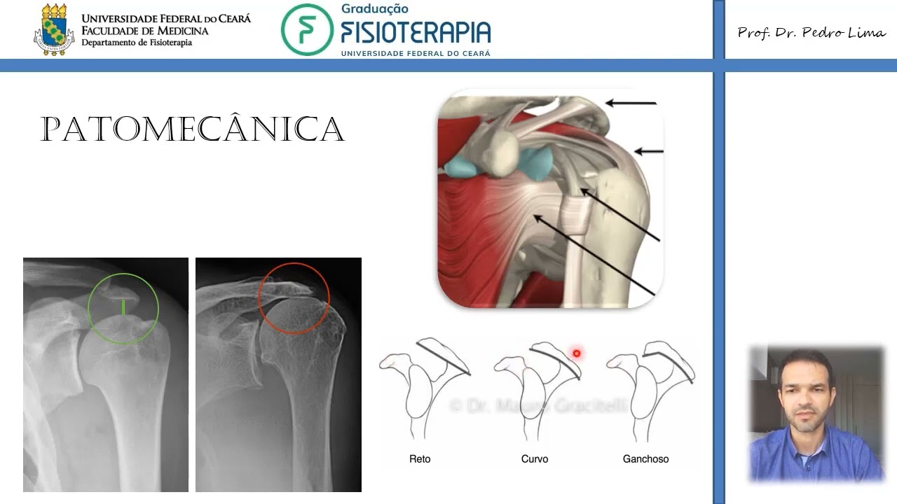 PATOMEC&Acirc;NICA DO OMBRO S&iacute;ndrome do Impacto [Biomec&acirc;nica]