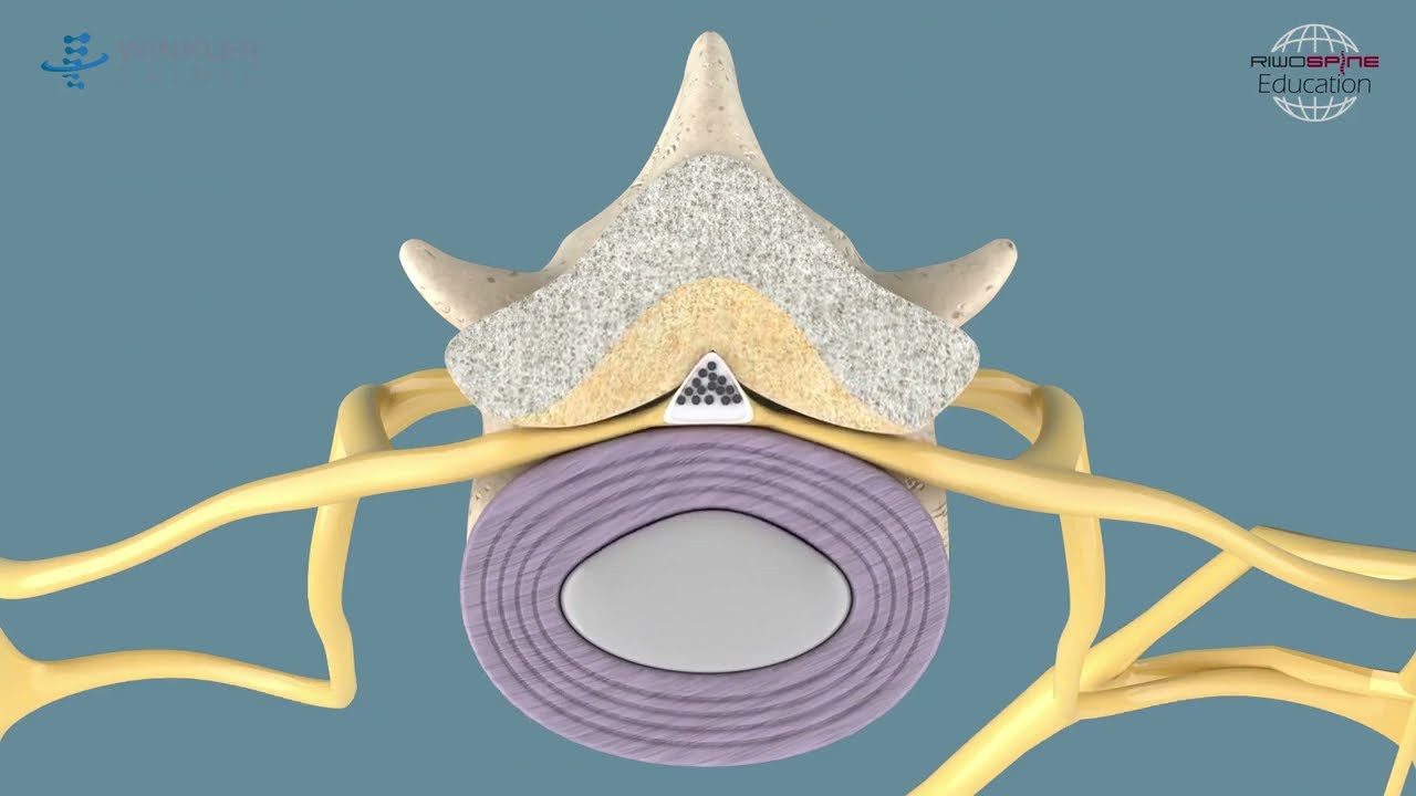 Descompresión endoscópica para conducto lumbar estrecho o estenosis lumbar.
