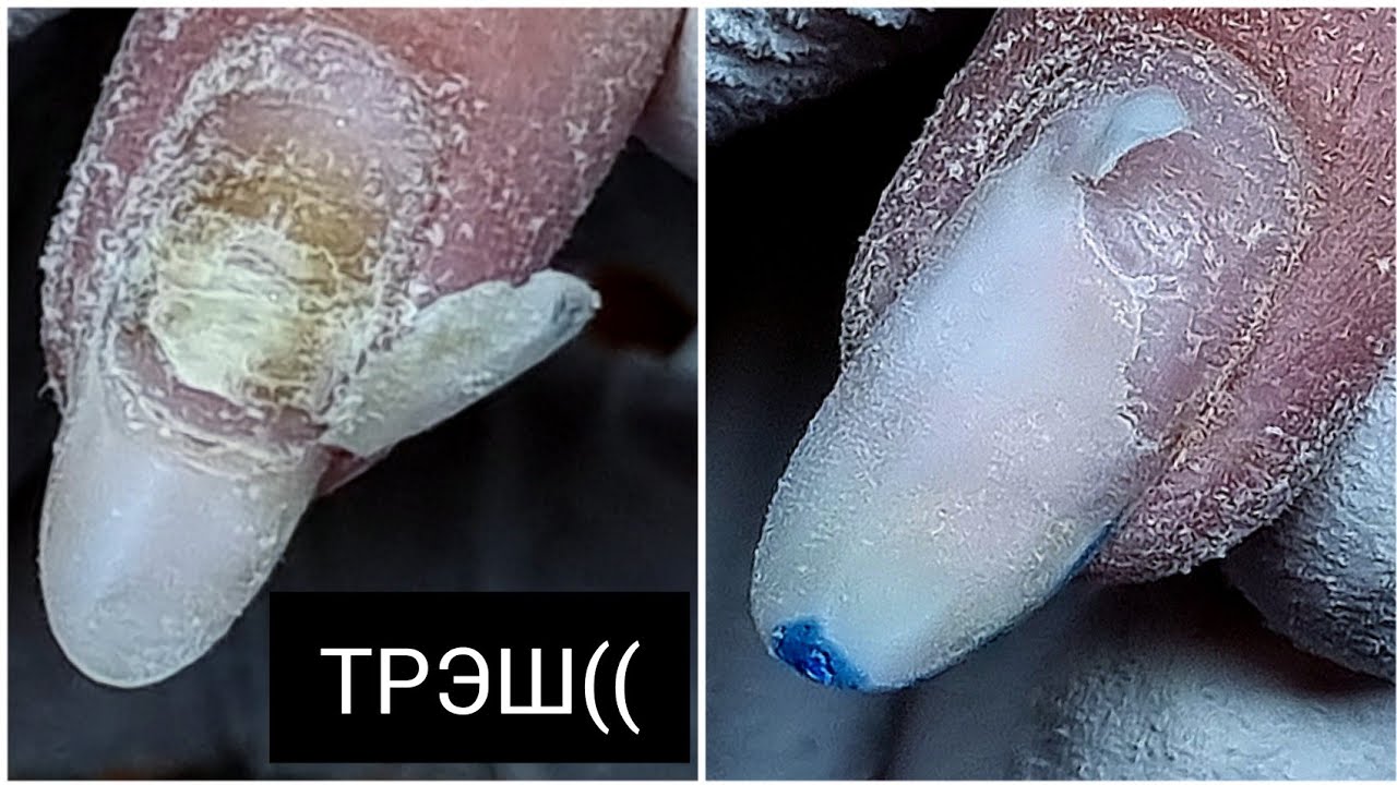 ЖУТКИЕ отслойки ((((