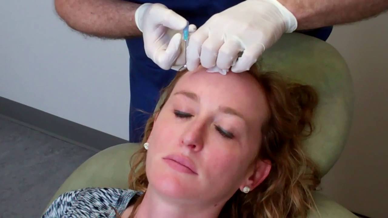 Brow Lift with PDO threads Lawrence Janowski, MD