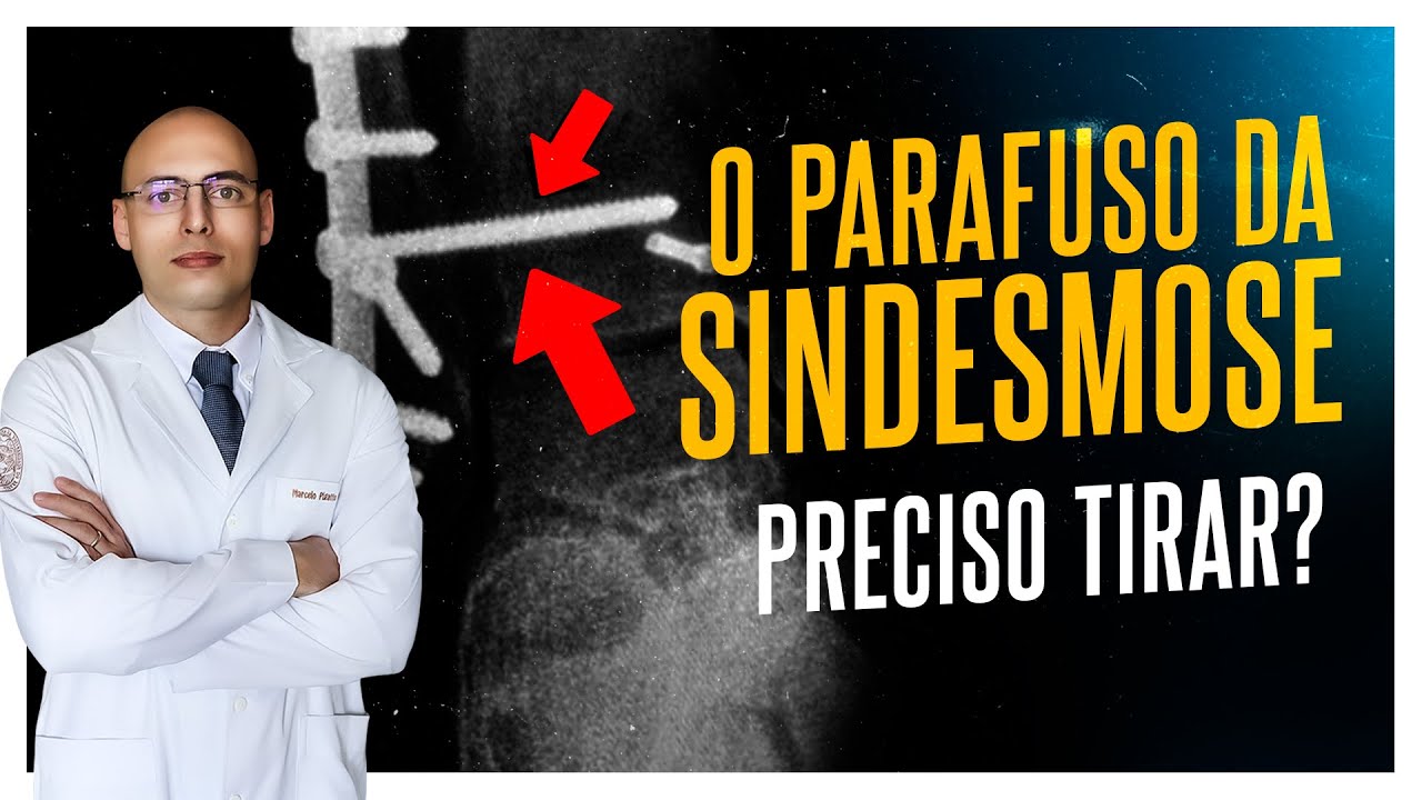 PRECISO RETIRAR O PARAFUSO DA SINDESMOSE?