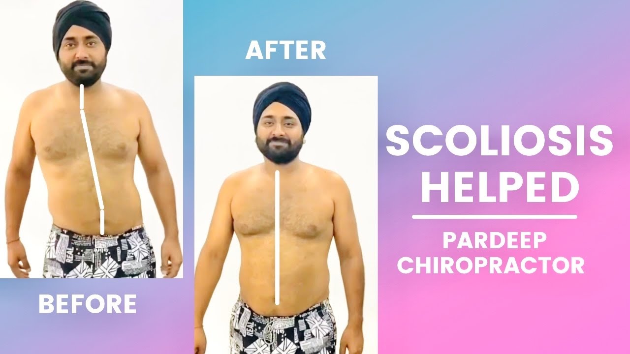 Major Scoliosis And Difficultly To Walk | Pardeep Chiropractor | Ph 9988170101