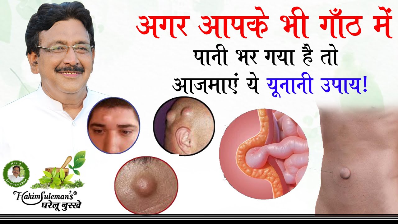 कलौंजी के सिरके से सुखाएं गाँठ का पानी ! Hakim Suleman Khan | Unani |
