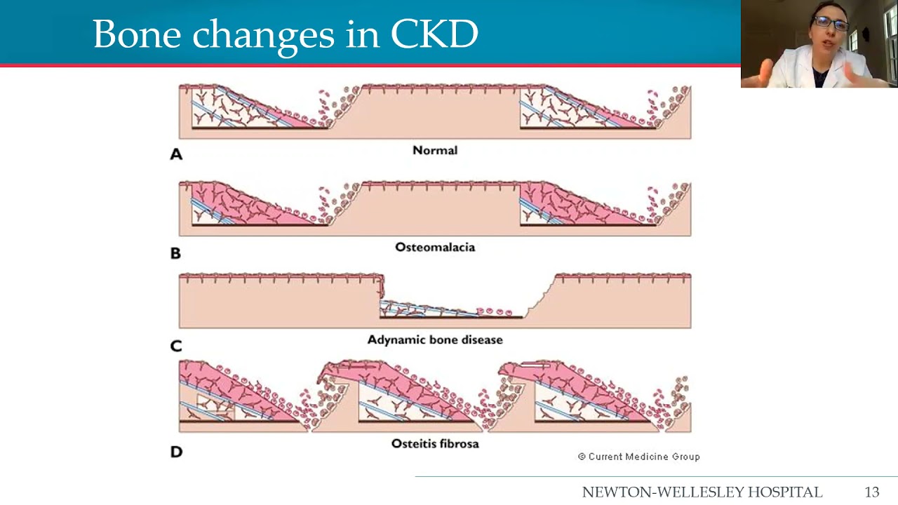 Newton-Wellesley Medical Group Lunch & Learn: Bone disease and CKD