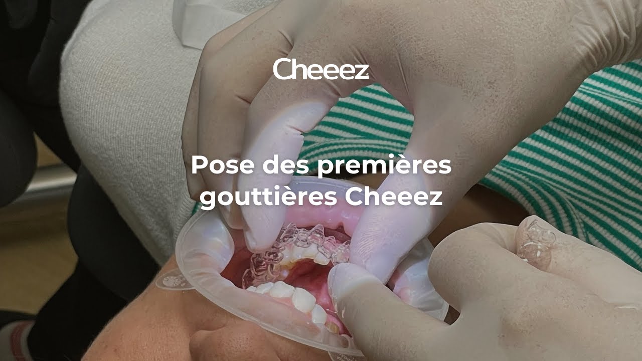 Aligneurs Cheeez : Pose des premières gouttières d'alignement