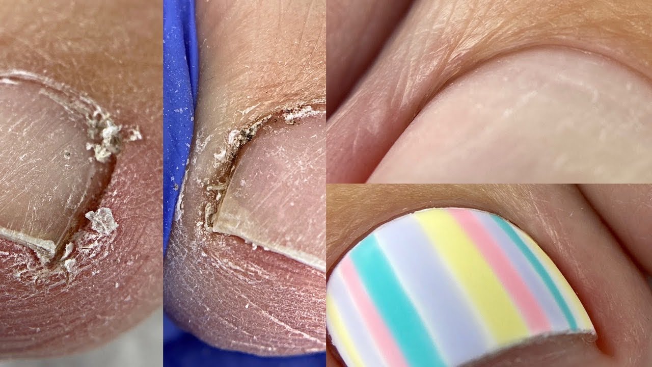 Как убрать подногтевую мозоль подробно💅Возрастной педикюр💅 Летний дизайн ногтей