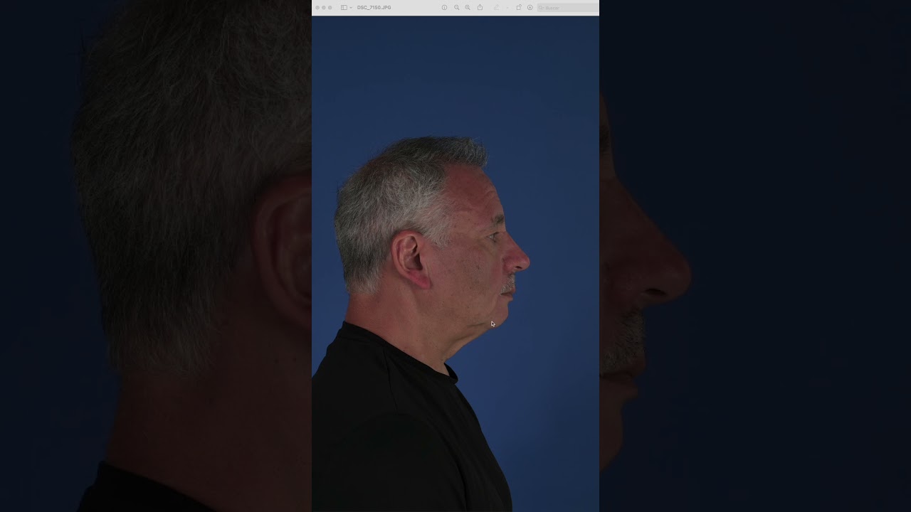 Caballero de 62 a&ntilde;os a solo 12h de #rejuvenecimientofacial / 62 yo gentleman 12h after #facelift