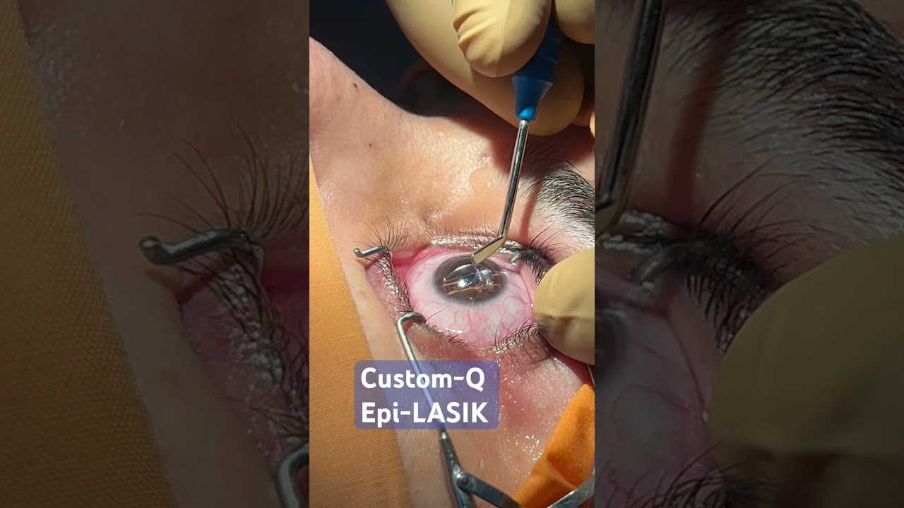 Custom-Q Epi-Lasik for specs removal #epilasik #drsudhirsrivastav #suneyecafe