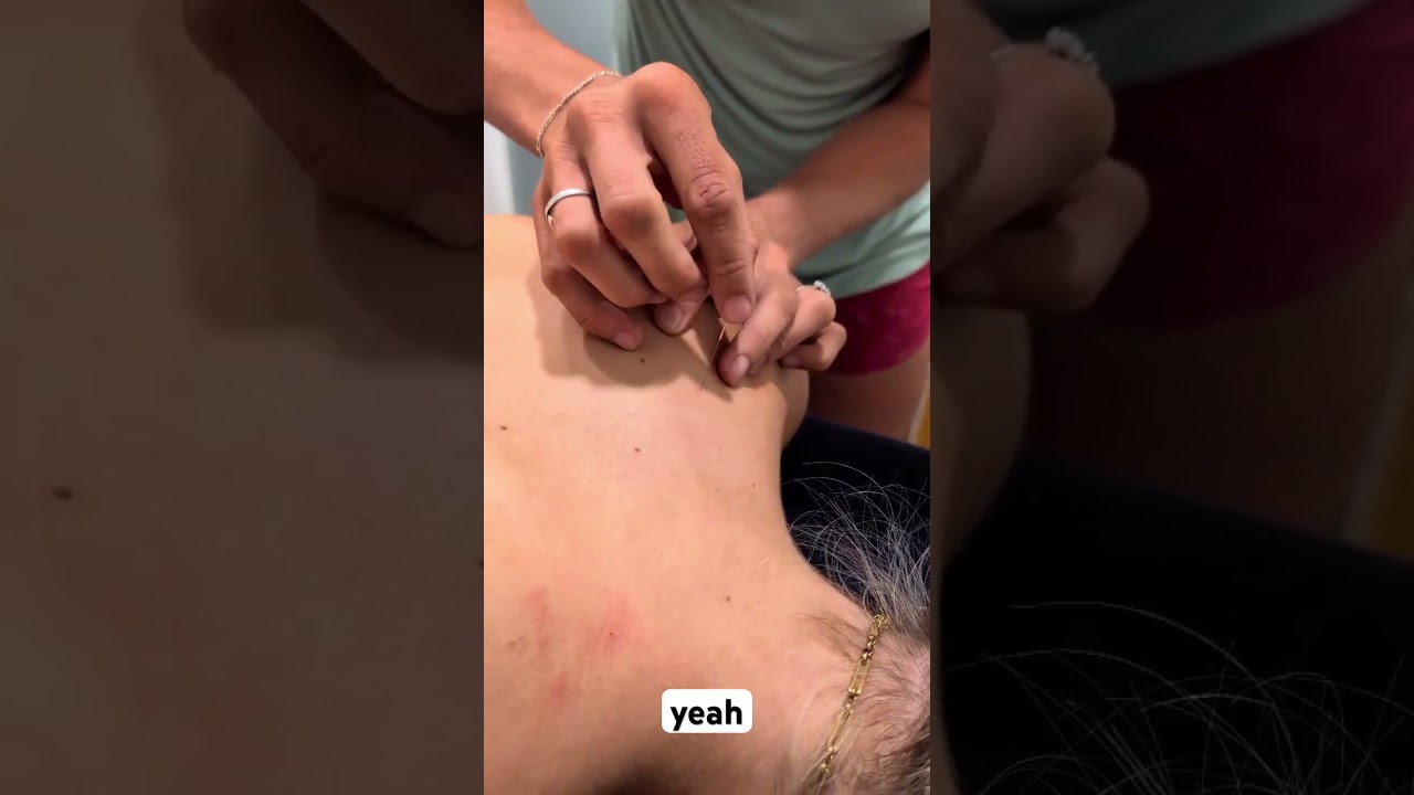 Upper Thoracic Dry Needling You NEED to See 👇