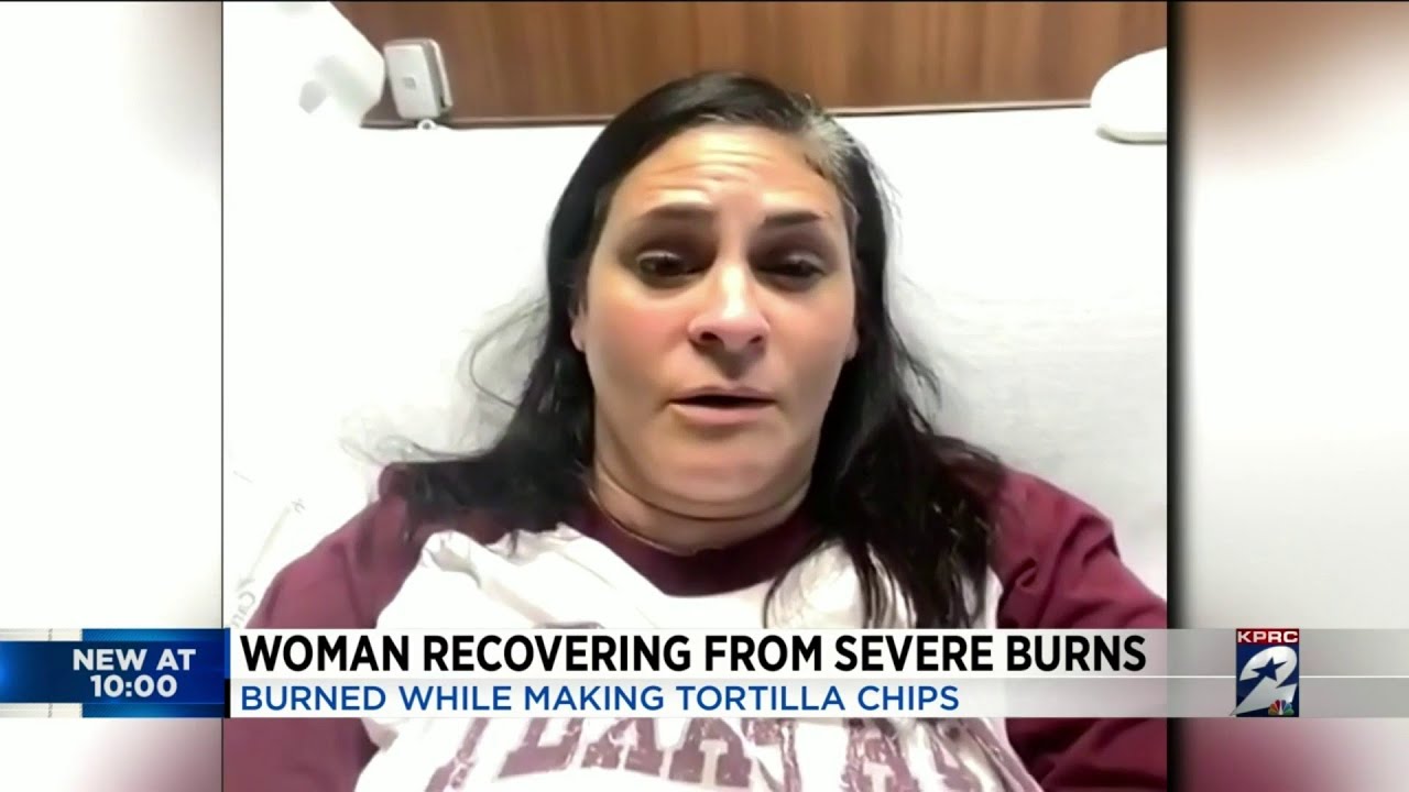 Woman recovering from severe burns