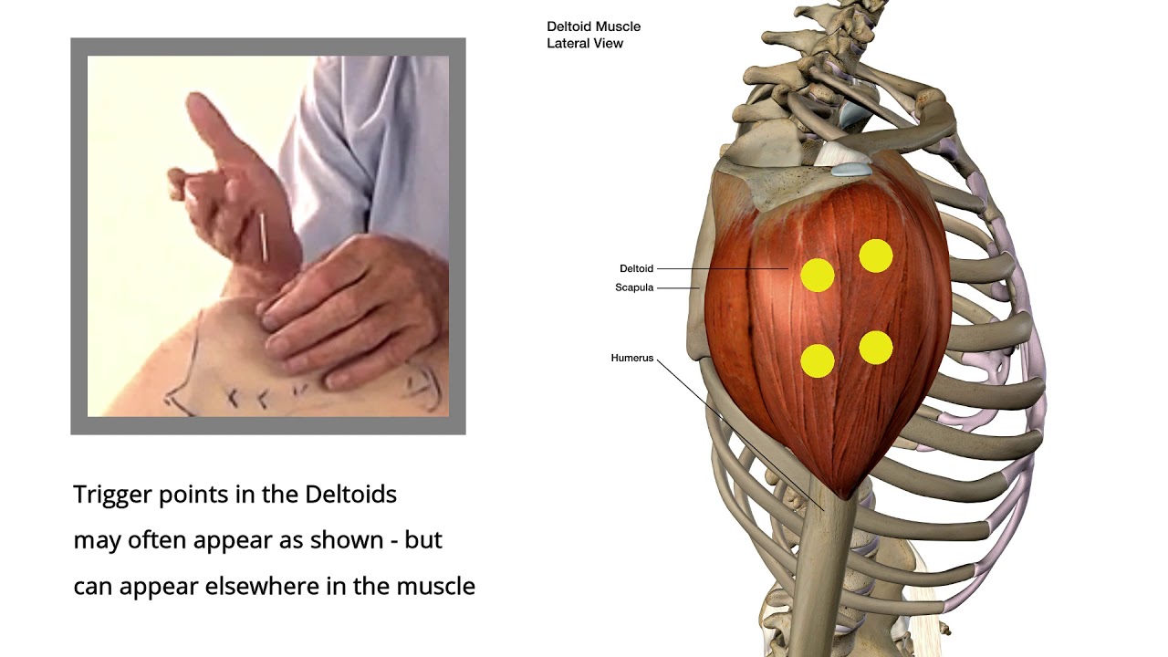 Dry Needling | Trigger Point Release | Deltoids