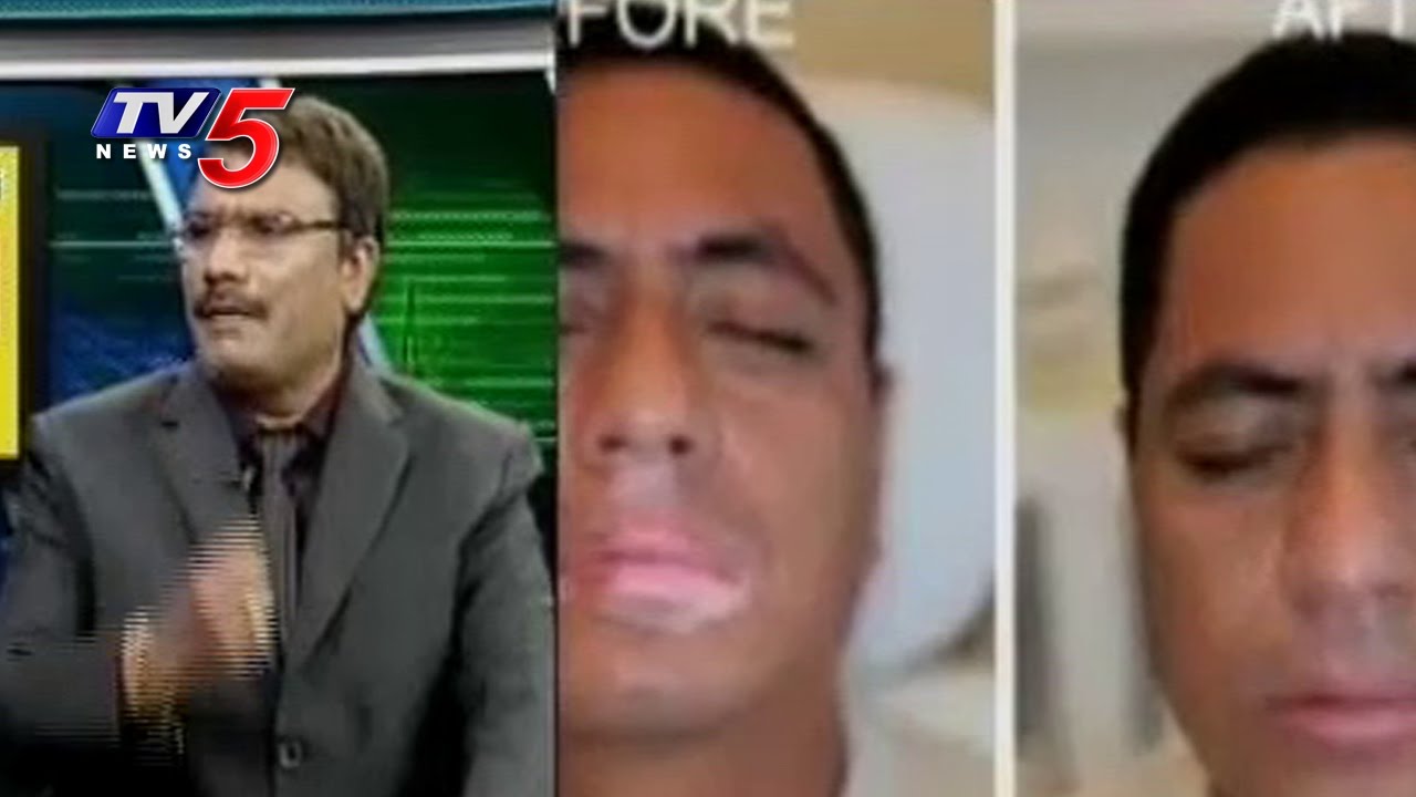 Vitiligo (Bolli) Causes, Symptoms and Treatments | Health File | TV5 News