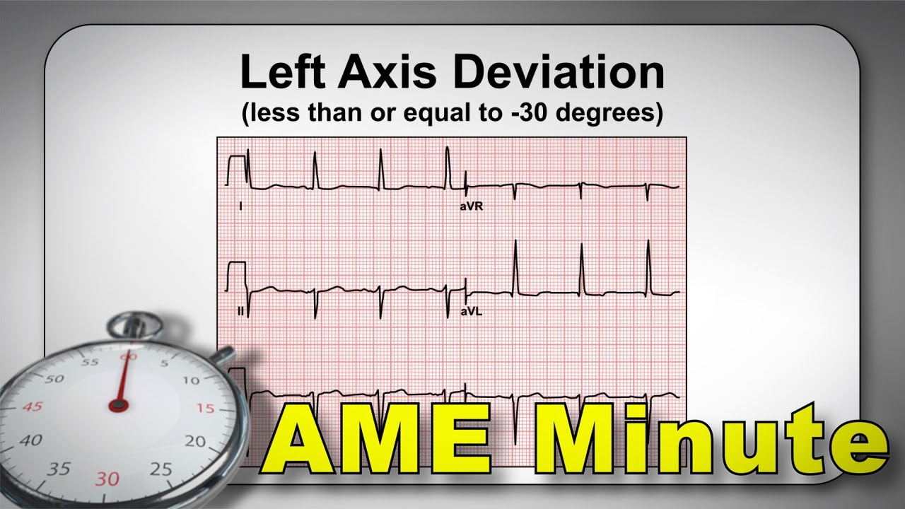 AME Minute: Identification of ECG Normal Variants Reduces Delays - Part 5