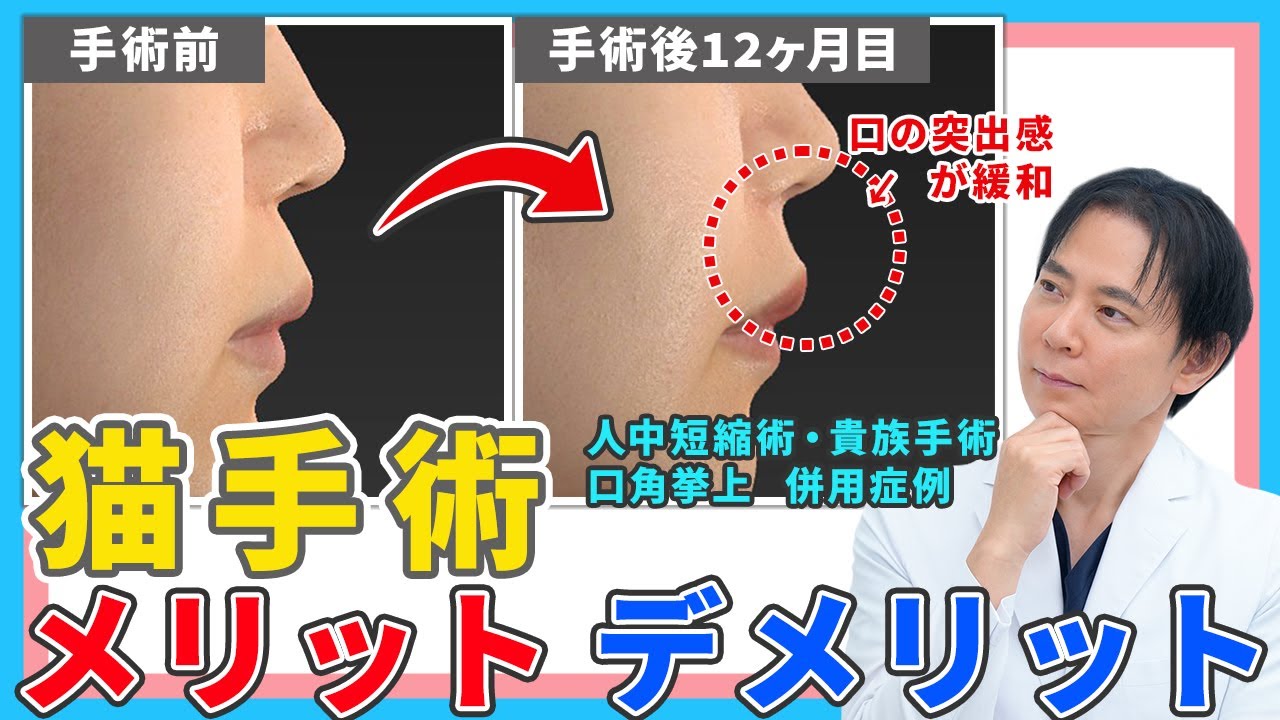 【猫手術】鼻唇角形成術で口元の突出が改善｜メリットとデメリットを解説