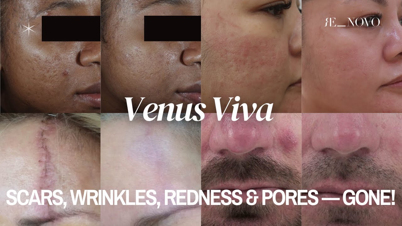 Venus Viva Explained: Skin Resurfacing for Scars, Wrinkles & Pores (Safe for All Skin Types!