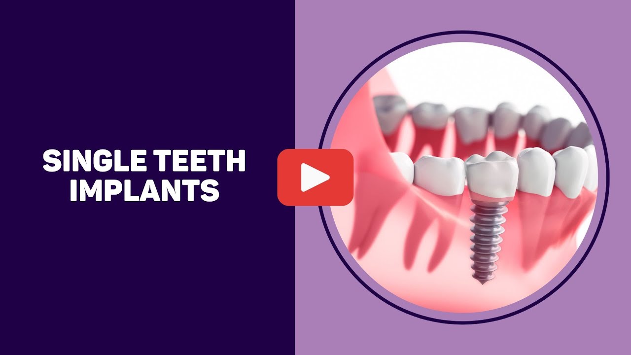 Single teeth implants
