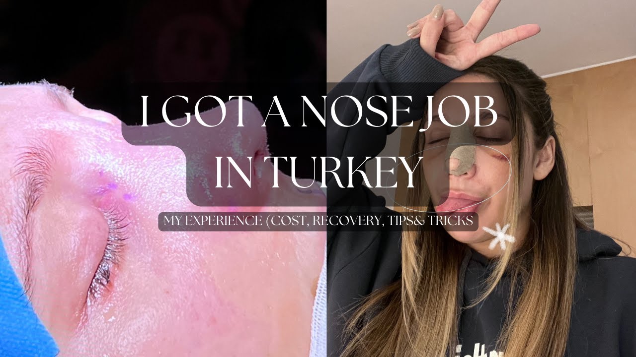 I GOT A NOSE JOB IN TURKEY! (My Experience)