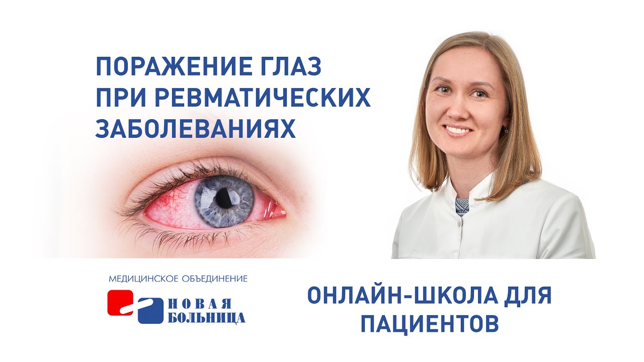 Поражение глаз при ревматических заболеваниях. Онлайн-школа для пациентов