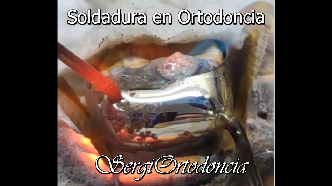 ¿Cómo Soldar en Ortodoncia? (En 1 Minuto)