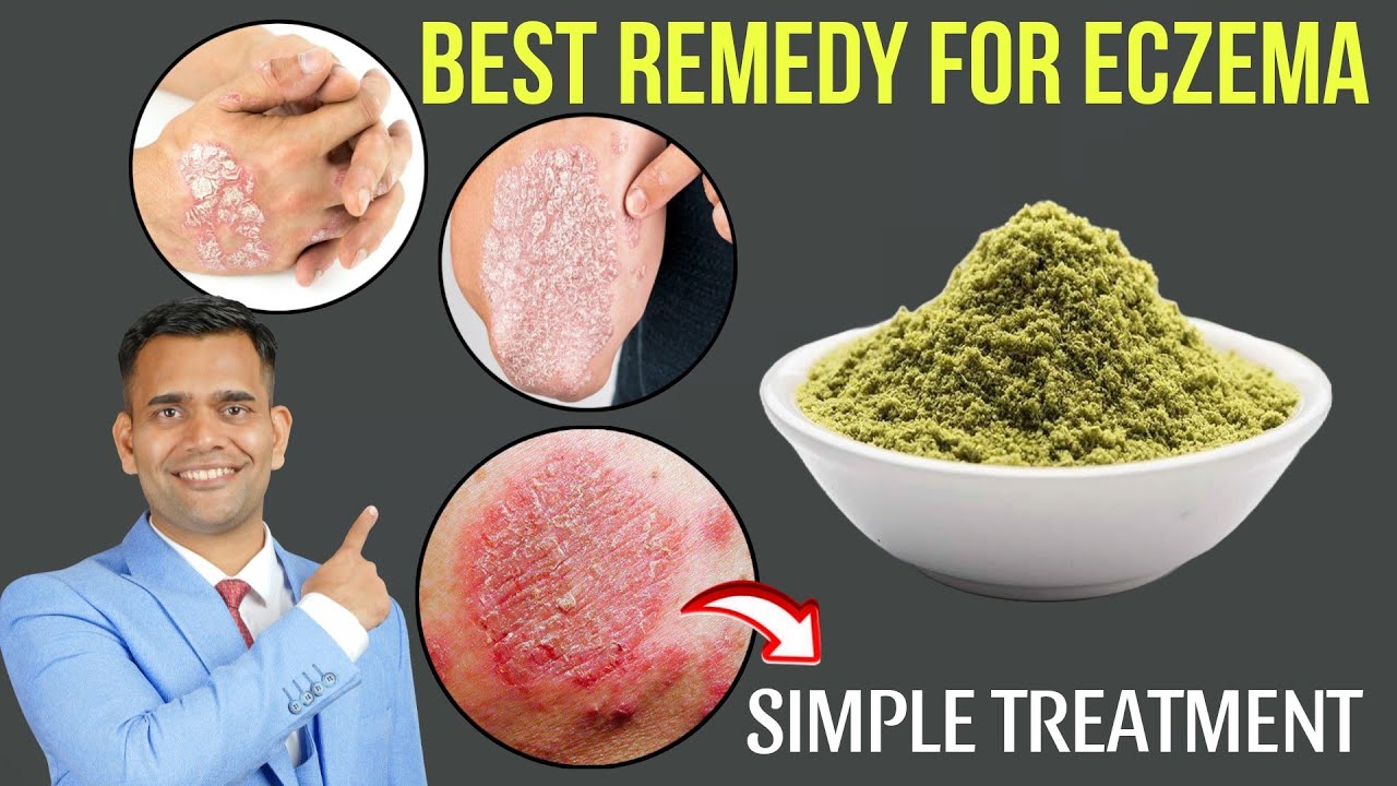 Best Natural Treatment For Eczema | How To Get Rid Of Eczema Naturally - Dr. Vivek Joshi