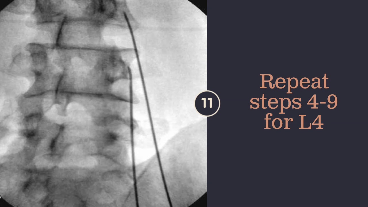 5 Minute Lumbar Medial Branch Radiofrequency Ablation