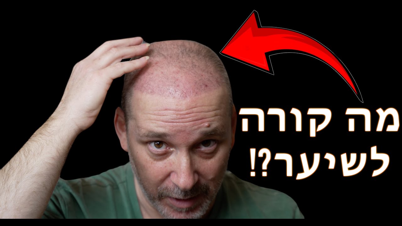❗3 חודשים אחרי השתלת שיער – זה מה שבאמת קורה