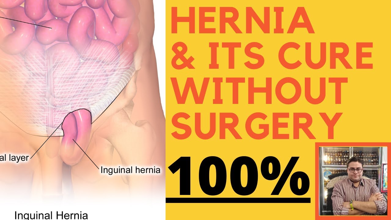 hernia || inguinal hernia homeopathic medicine || homeopathic treatment for hernia !