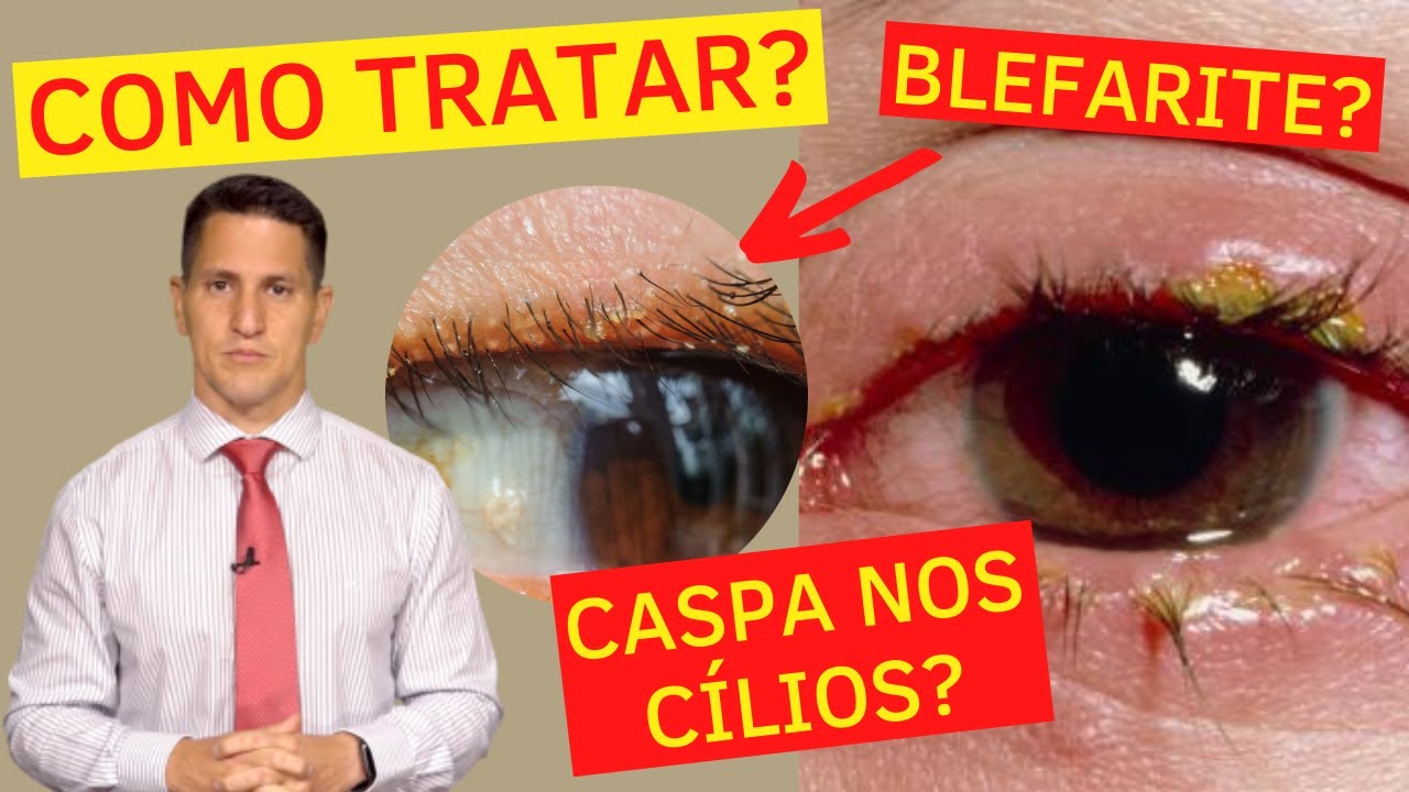 COMO ACABAR COM A CASPA NOS CÍLIOS? - TRATAMENTO DA BLEFARITE | Dr. Arthur Farache