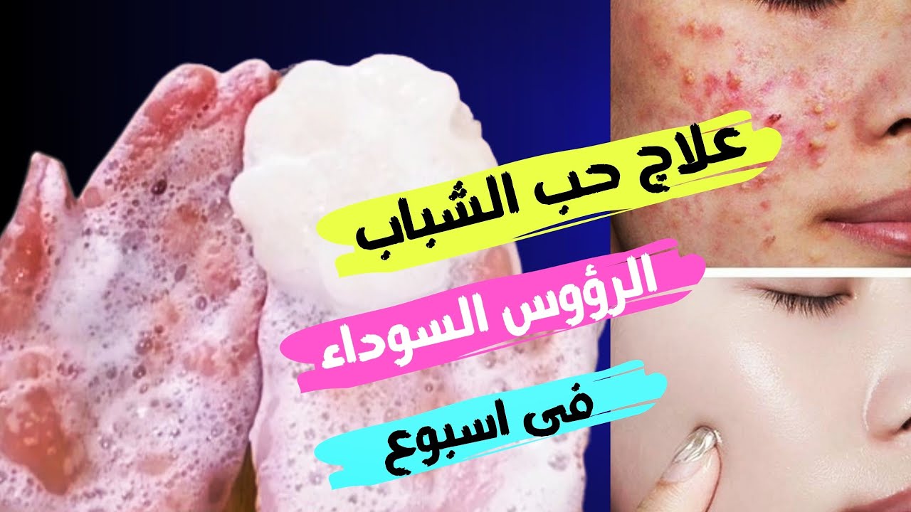 طريقة عمل صابون ساليسيلك اسيد | علاج الرؤوس السوداء و حبوب تحت الجلد و حب الشباب فى اسبوع