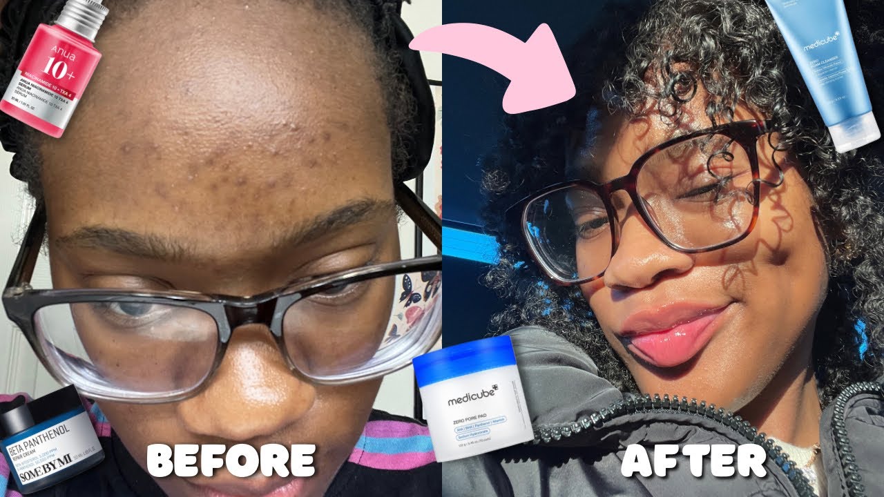 KOREAN SKINCARE ROUTINE 🫧 | How I Cleared My Acne-Prone Skin | Vlogmas Day 11