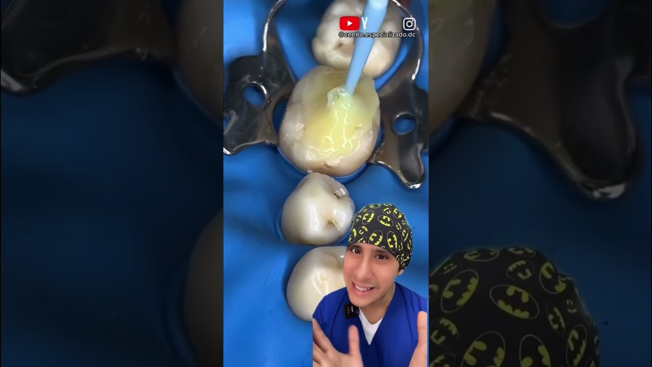 Hoy te explicamos como es el proceso de curacion dental #diente #curacion #explicacion #caries