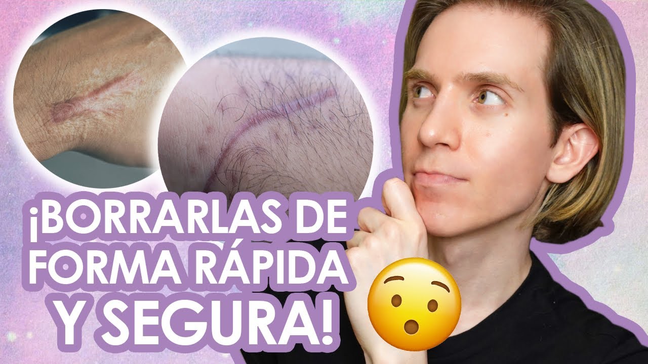 COMO PREVENIR Y BORRAR CICATRICES  - Redomendaciones de un dermatólogo