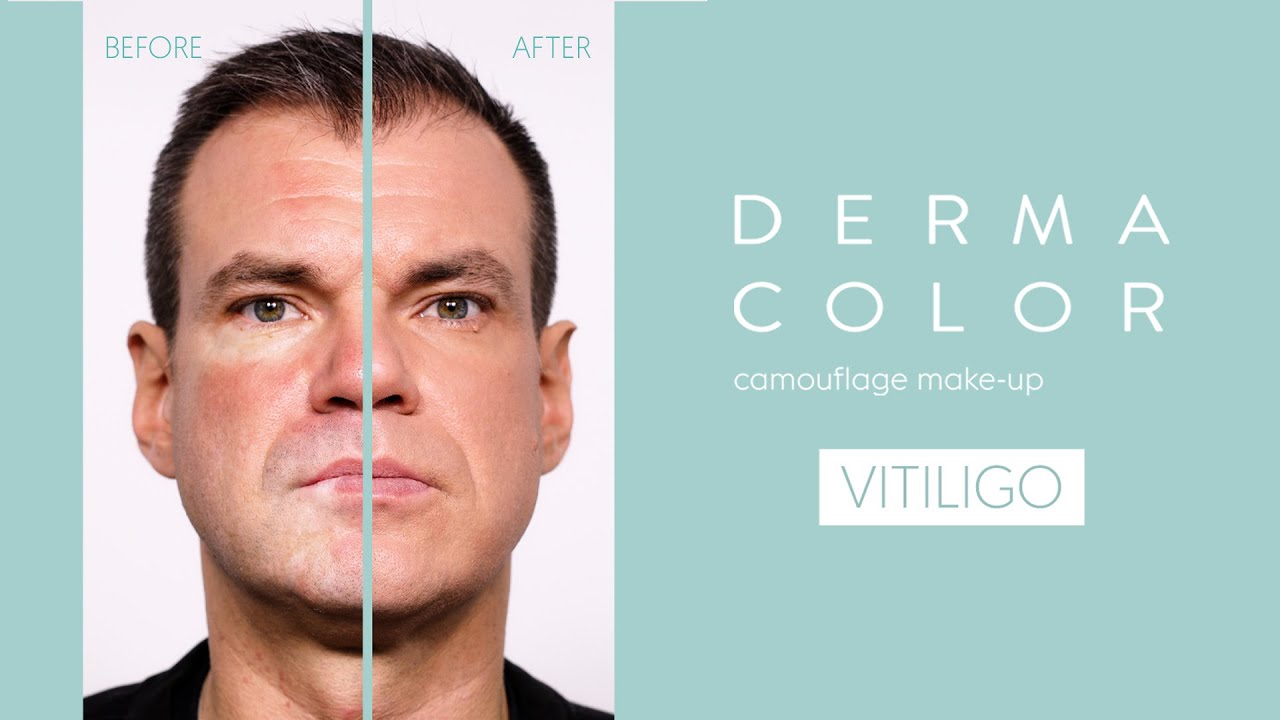 Как замаскировать витилиго с помощью Dermacolor | Учебник по макияжу Kryolan для безупречного пок...
