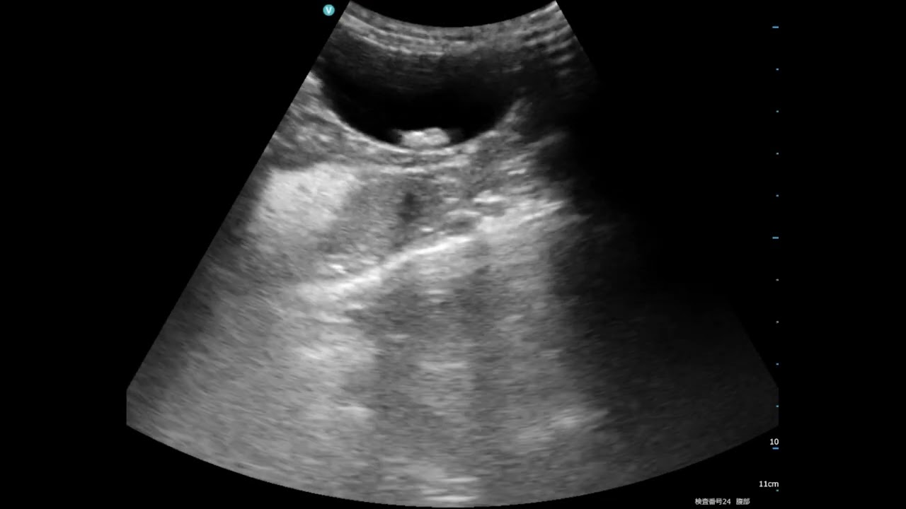 Bladder stones、Pocket size vs Stationary high-end system、eho images、dog（3kg)犬の尿石症