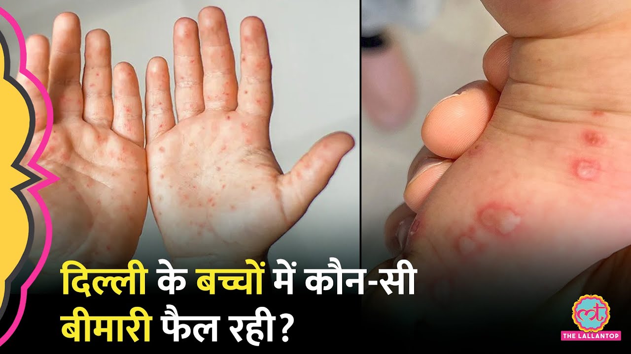 हाथ में दाने, पैर में छाले, Delhi के बच्चों में कैसी बीमारी, Classes Online | HFMD