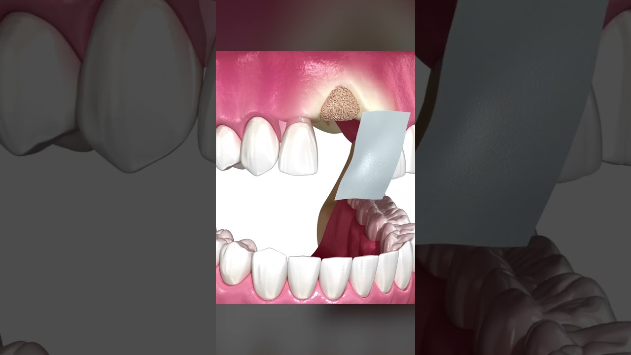 ENTENDA O ENXERTO ÓSSEO PARA IMPLANTES!