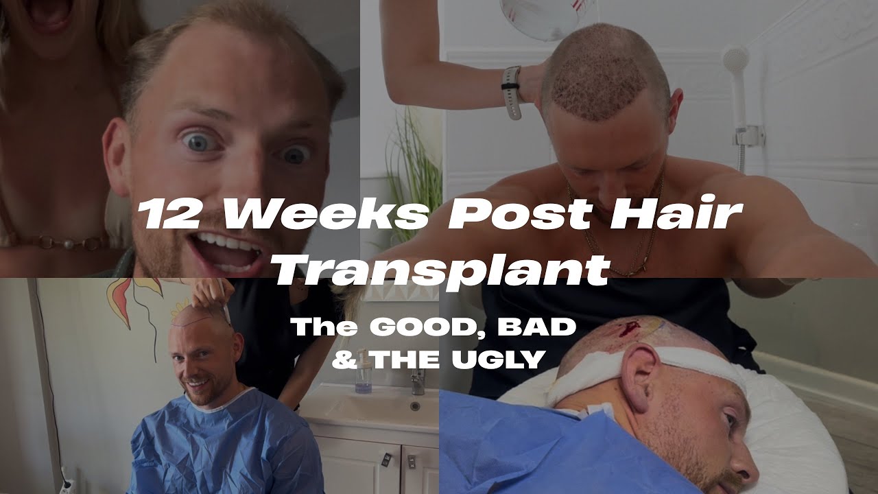 12 Weeks Post Hair Transplant: The Good, Bad & the UGLY